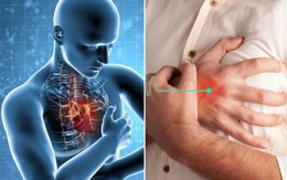 Người đàn ông 56 tuổi nhồi máu cơ tim cấp từ dấu hiệu nhiều người Việt bỏ qua
