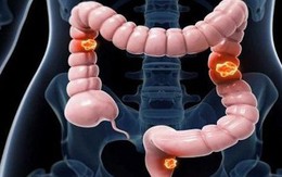 Nam sinh viên 22 tuổi mắc ung thư đại tràng giai đoạn 4 thừa nhận bỏ qua 3 dấu hiệu báo bệnh này
