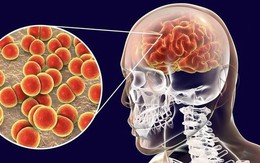 Bệnh do não mô cầu có thể diễn tiến tối cấp: 5 dấu hiệu cha mẹ không nên bỏ qua