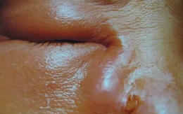 Sáng ngủ dậy nước mắt “dính như keo”, người phụ nữ đi khám phát hiện điều bất ngờ