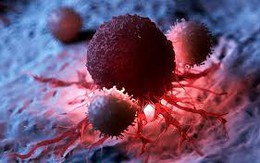 Người đàn ông 67 tuổi phát hiện ung thư phổi từ dấu hiệu nhiều người Việt mắc phải