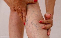 5 điều bác sĩ mạch máu nhắn nhủ bệnh nhân suy giãn tĩnh mạch ăn Tết vui khỏe, hạn chế gặp nhau trong bệnh viện