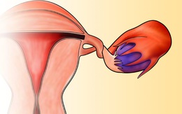 Thiếu nữ 16 tuổi suýt mất buồng trứng sau cơn đau dữ dội trong đêm, chị em có dấu hiệu này cần khám gấp