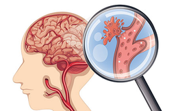 Tai biến mạch máu não: Hiểu đúng bệnh để phòng ngừa từ sớm