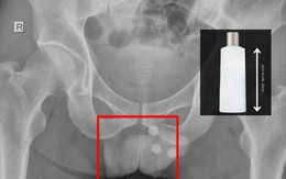Chai nhựa dài 20cm mắc kẹt trong trực tràng người đàn ông, bác sĩ cảnh báo biến chứng nguy hiểm