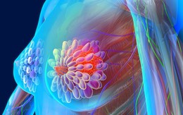 Người phụ nữ 41 tuổi phát hiện ung thư vú thừa nhận 1 sai lầm nhiều chị em Việt mắc phải