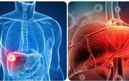 Người đàn ông 63 tuổi phát hiện ung thư gan thừa nhận 1 sai lầm nhiều người Việt mắc phải