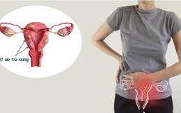 Người phụ nữ 45 tuổi thoát u xơ tử cung nhờ kỹ thuật 'bỏ đói' khối u