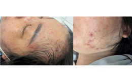 Mắc bệnh thủy đậu khi mang thai, thai phụ đối mặt nguy cơ gì?