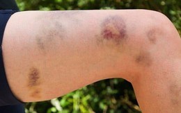 Người phụ nữ 40 tuổi đang khỏe mạnh bỗng nguy kịch sau 2 tháng mắc sai lầm này khi dùng thuốc