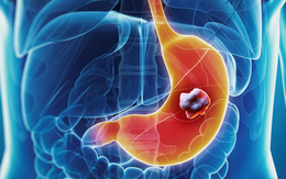 Người phụ nữ 55 tuổi mắc ung thư dạ dày giai đoạn 4 gặp may mắn: Cơ hội điều trị tốt sau ca mổ