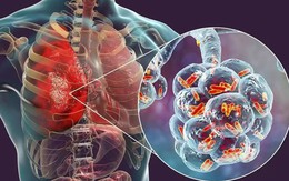 Người đàn ông 60 tuổi phát hiện sớm ung thư phổi hiếm gặp nhờ làm 1 việc mà nhiều người Việt bỏ qua