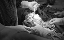 Người phụ nữ 28 tuổi phát hiện u xơ tử cung, nguy cơ cao gây biến chứng từ 1 việc nhiều người Việt bỏ qua