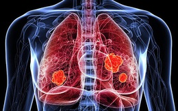 Người phụ nữ 66 tuổi nhập viện mới phát hiện ung thư phổi giai đoạn muộn từ dấu hiệu nhiều người Việt bỏ qua