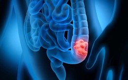 Người phụ nữ 66 tuổi phát hiện ung thư trực tràng từ polyp, thừa nhận 1 sai lầm nhiều người Việt mắc phải