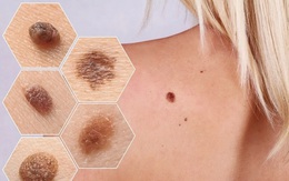 Người phụ nữ phát hiện mắc ung thư hắc tố ở cơ quan sinh dục từ dấu hiệu dễ bị bỏ qua sau mãn kinh