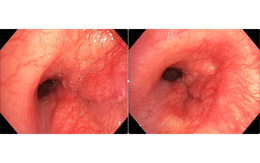 Người đàn ông 32 tuổi phát hiện ung thư phổi hiếm gặp từ dấu hiệu nhiều người Việt mắc phải