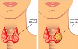 Chủ quan với nhân tuyến giáp, người phụ nữ trẻ đi khám phát hiện 13 hạch di căn