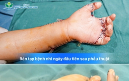 Bé 7 tuổi suýt mất bàn tay vì máy tự chế, hồi chuông cảnh báo trong nhiều gia đình
