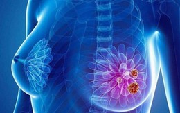 Người phụ nữ phát hiện ung thư vú từ dấu hiệu ít ai ngờ tới