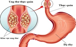 Người đàn ông đang khỏe mạnh phát hiện ung thư thực quản, thừa nhận 2 sai lầm nhiều nam giới Việt mắc phải