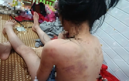 Vụ nữ sinh lớp 4 nghi bị bạn đánh hội đồng: Cao Bằng yêu cầu khẩn trương kiểm tra, xử lý
