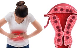 Mắc đái tháo đường, người phụ nữ 45 tuổi suýt gặp biến chứng nặng vì bệnh phụ khoa kéo dài