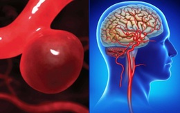 Đau đầu, buồn nôn kéo dài, người phụ nữ 44 tuổi bất ngờ phát hiện phình động mạch não