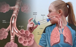 Liệu pháp sinh học - giải pháp điều trị hen suyễn mới