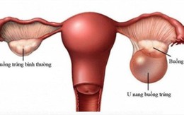 Phát hiện u buồng trứng khổng lồ sau 2 năm bỏ tái khám, người phụ nữ 68 tuổi thừa nhận sai lầm nhiều chị em mắc phải