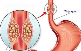 Cô gái 26 tuổi bị loét thực quản vì thói quen nhiều người Việt mắc phải khi uống thuốc