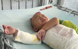 MS 1108: Bé trai dân tộc H’Mông 3 tuổi bị bỏng nặng cần sự giúp đỡ