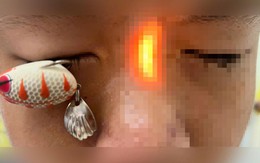 Bé trai 13 tuổi đi cấp cứu với lưỡi câu ghim sâu trong mắt