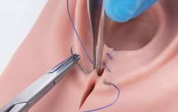 Thẩm mỹ vùng kín, chị em cần biết 4 điều để tránh biến chứng
