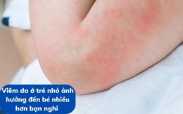 Viêm da ở trẻ nhỏ ảnh hưởng đến bé nhiều hơn bạn nghĩ