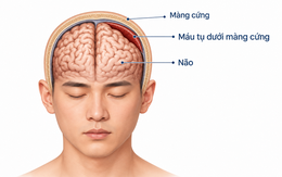 Đau đầu kéo dài 7 ngày, nam bệnh nhân 32 tuổi phát hiện tụ máu dưới màng cứng dày 19 mm