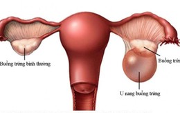 Phát hiện u đặc buồng trứng sau mãn kinh, người phụ nữ 60 tuổi phải phẫu thuật cắt tử cung và hai phần phụ