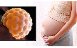Người phụ nữ 49 tuổi tưởng tiền mãn kinh, bất ngờ phát hiện chửa trứng từ dấu hiệu nhiều chị em dễ bỏ qua