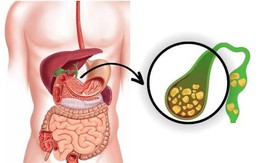Nguyên nhân gây sỏi mật và cách hạn chế nguy cơ hình thành sỏi