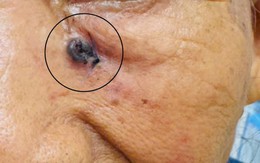 Người phụ nữ 69 tuổi tưởng vết trầy xước trên mặt, đi khám bất ngờ phát hiện ung thư da