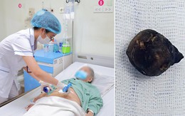 Chỉ uống men vi sinh vì tưởng đau bụng, cụ bà 90 tuổi phát hiện sỏi mật 25 mm mắc kẹt trong ruột