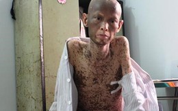 Nghị lực phi thường của người đàn ông mắc căn bệnh “quỷ ám”