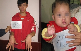 Lạ lùng nơi có nhiều người bị dính ngón