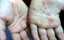 Nghi vấn trẻ mầm non bị cô giáo đâm kim