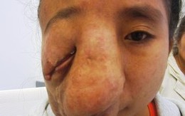 Bóc tách khối u, trả lại vẻ xinh đẹp cho cô gái bất hạnh 18 tuổi