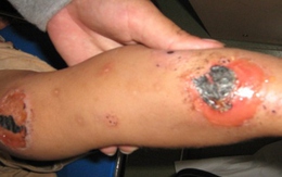 Kinh hoàng chốc lở da ở trẻ