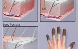 10 căn bệnh nguy hiểm nhất mùa Đông