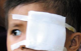Cấp cứu vì que hương đâm vào mắt