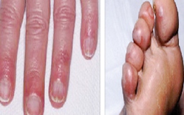 Những tổn thương cơ thể do lạnh 