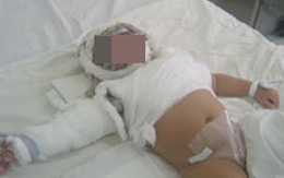 Bé 10 tháng tuổi bỏng mặt vì bình trà nóng